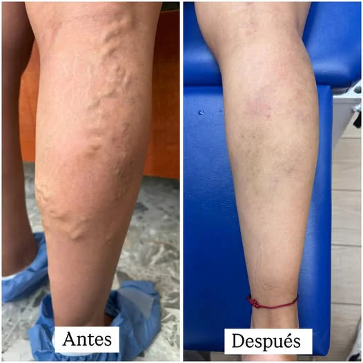 Velvora Compresión negro 20 - 30 mmHg